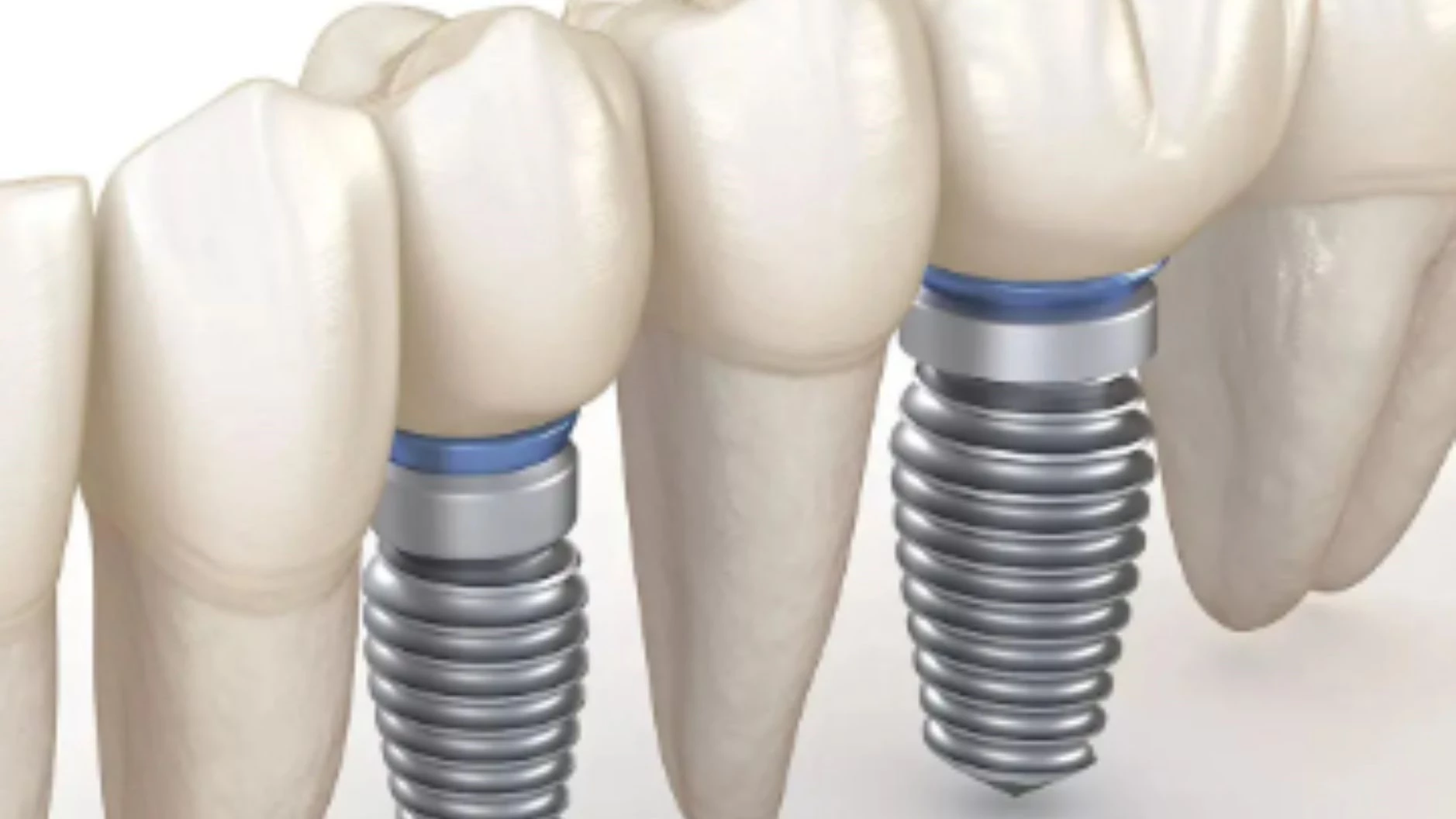 Am I a Candidate for Dental Implants? Essential Qualifications and Considerations