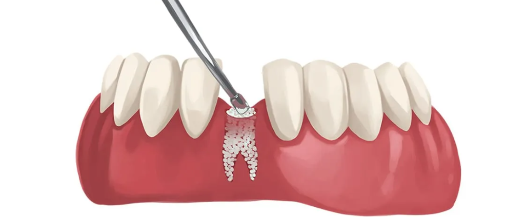 Illume Dental | Dentist McKinney TX | Bone Grafting