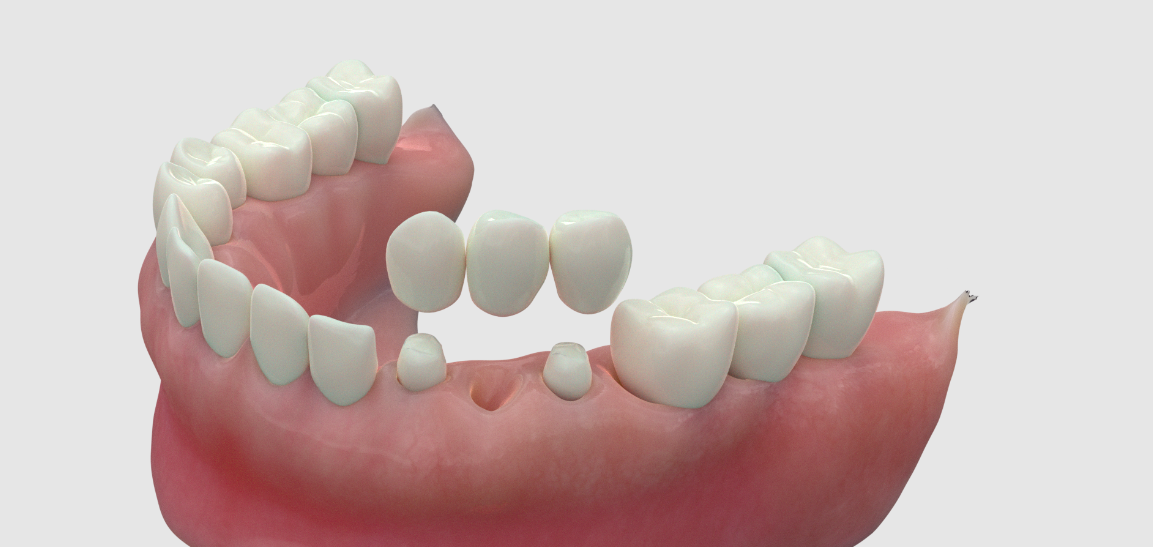 Illume Dental | Dentist McKinney TX | Dental Bridges
