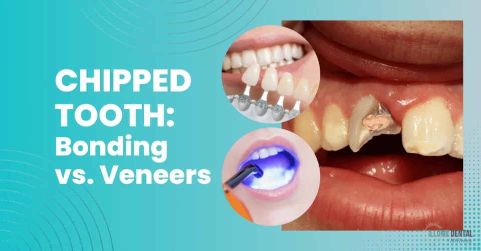 Chipped Tooth Bonding vs. Veneers