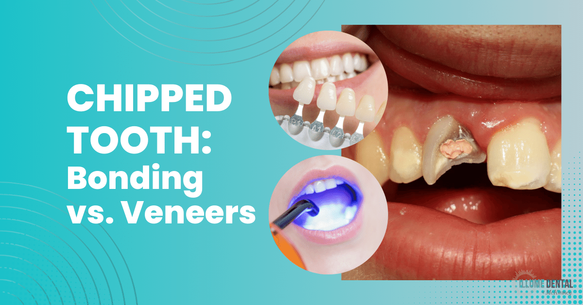 Chipped Tooth Bonding vs. Veneers