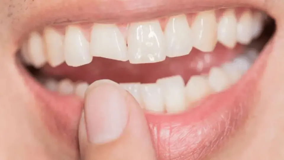 Cosmetic Dentistry Enhance Your Smile, Fix Broken Teeth