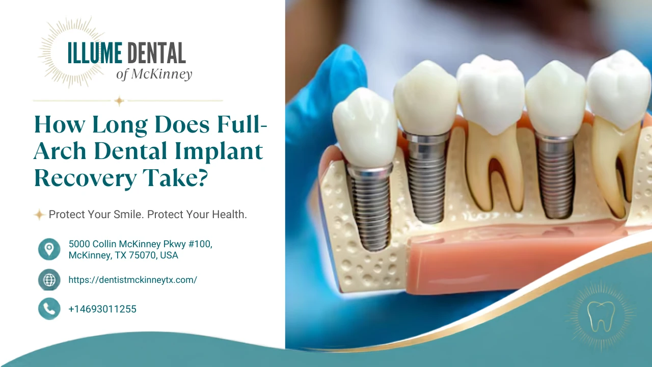 How Long Does Full-Arch Dental Implant Recovery Take? 2