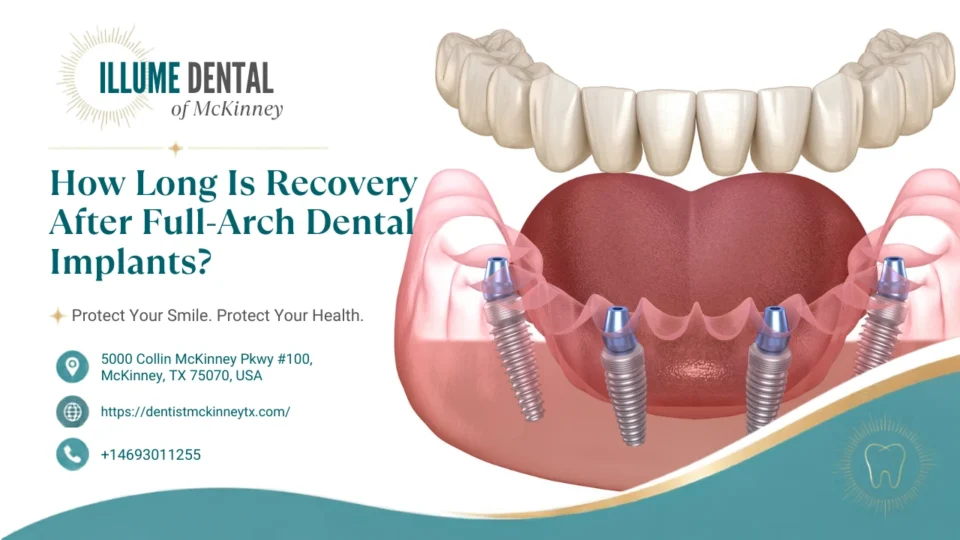 How Long Does Full-Arch Dental Implant Recovery Take?