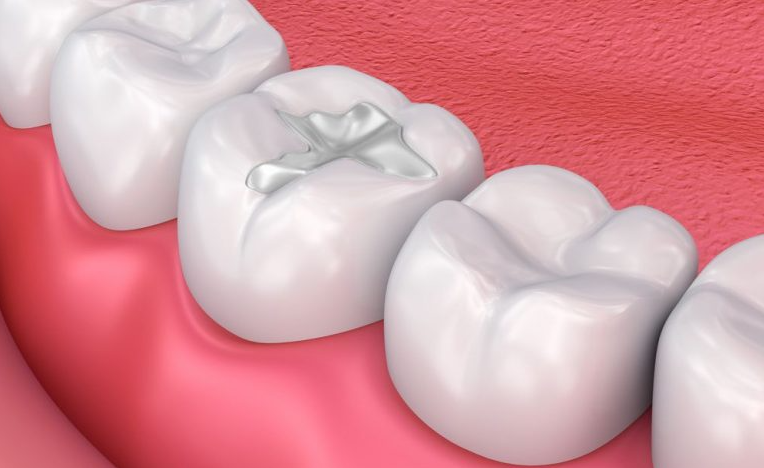 Illume Dental | Dentist McKinney TX | Tooth Fillings