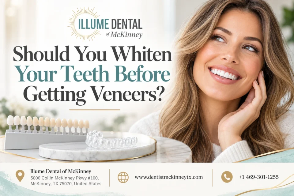 Should You Whiten Your Teeth Before Getting Veneers?
