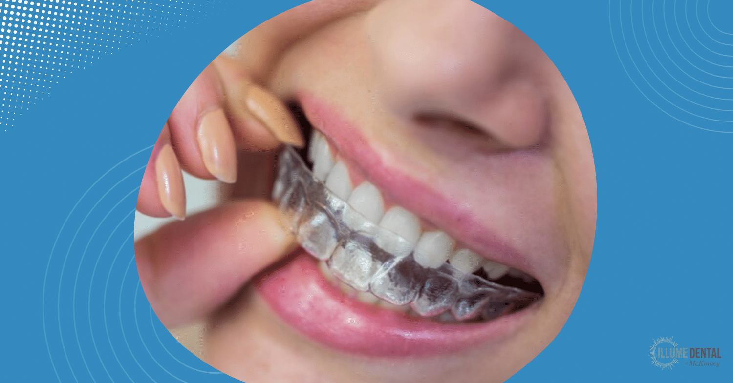 Invisible braces Clear Aligners in McKinney for Discreet Orthodontic Care