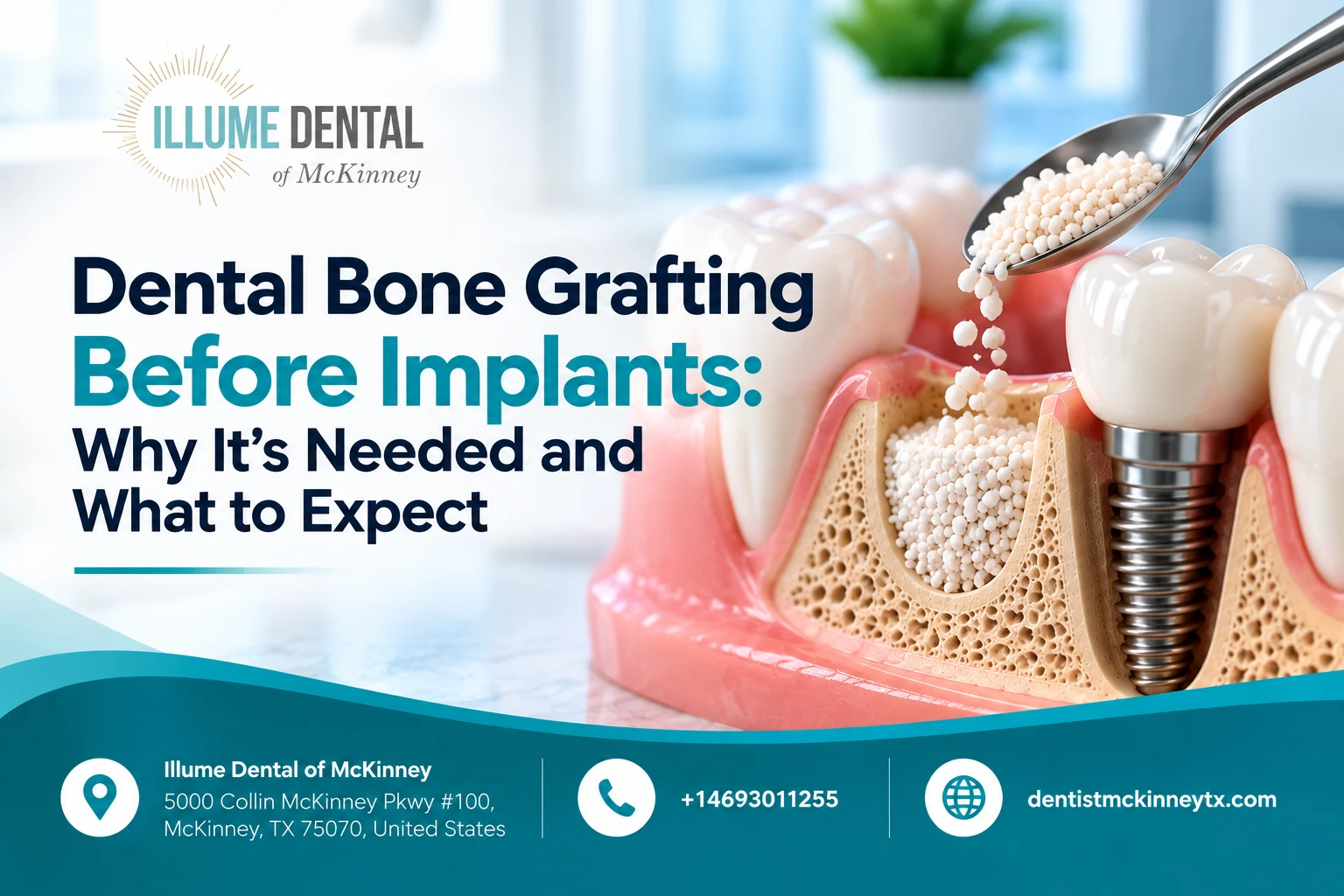 Dental Bone Grafting Before Implants: What to Expect