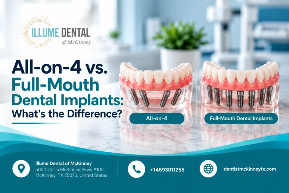 All-on-4 vs. Full-Mouth Dental Implants