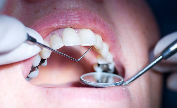 "patient having a dental examination up, close up with narrow depth of field focus on probe"