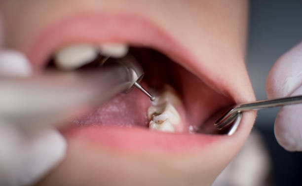 Cavity-Treatment