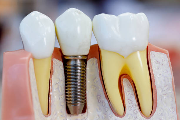 Close up of dental model with implantation